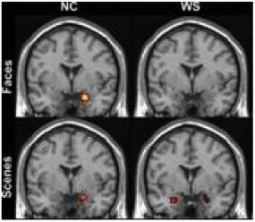 results of a brain scan